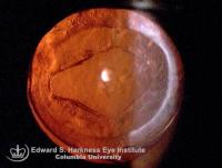 Posterior capsule opening after Nd:YAG laser capsulotomy